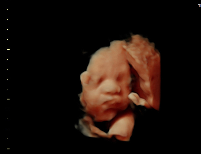 3D ultrasound image at 29 weeks